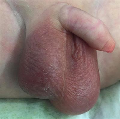 Bilateral Neonatal Testicular Torsion; Hidden Surgical Nightmare